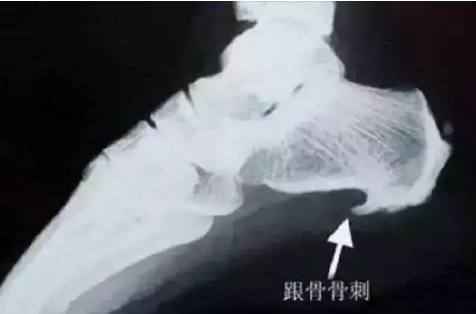 有“骨刺”，到底要不要剔除？