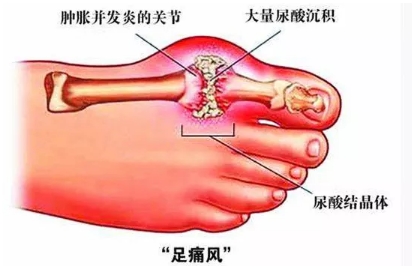 高尿酸、痛风，真凶是谁？如何推迟发作？有些知识需知道
