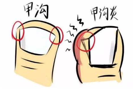 指甲往肉里长，一碰特别疼，甲沟炎该怎么办？