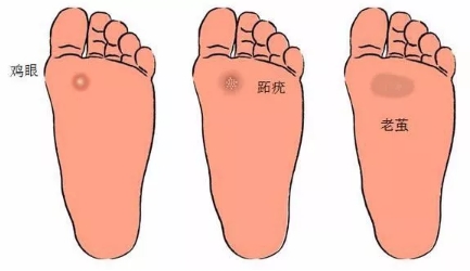 你脚上长的到底是鸡眼、老茧、还是跖疣？