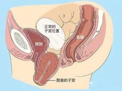 子宫脱垂，中国女性发病率高达1/4，301专家想要免费治！