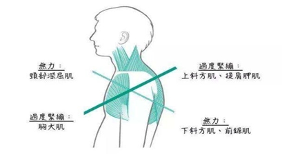 含胸、驼背、颈肩痛，小心患上上交叉综合征！