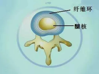 腰间盘突出压迫到神经，怎么办才能好，怎么做才能不加重？