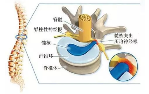 腰疼的“这个脖，治疗一定要趁早！