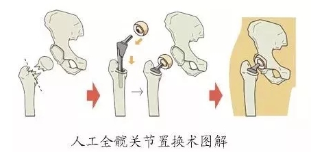 73岁关节置换后跳广场舞，53岁关节置换瘫在床，关键因素是什么？