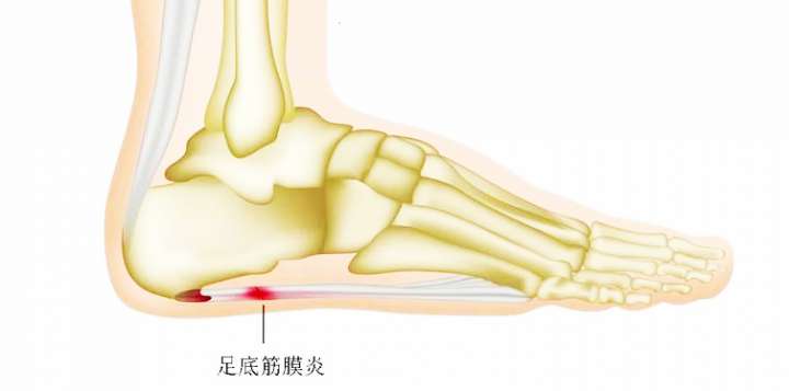 足脊健康说|足底筋膜炎的定义、诱发因素及自我评测方法