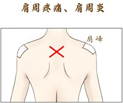 哪里疼痛贴哪里？贴了半辈子的膏药可能贴错了！