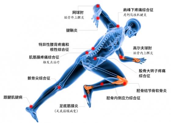 “看见”疼痛，精准治疗——超声引导下的冲击波治疗